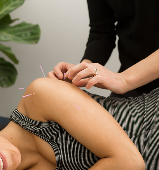 Acupuncture